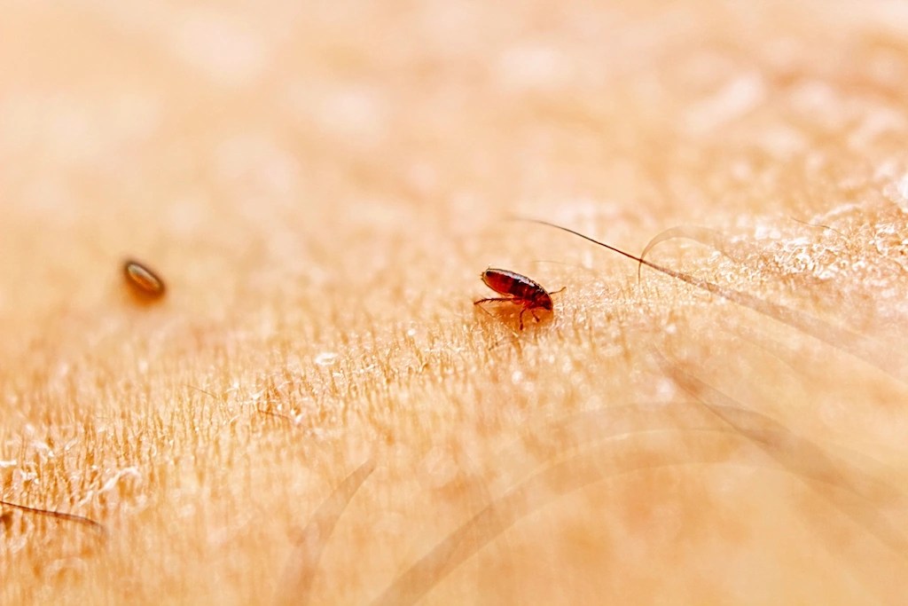 What Diseases Can Be Caused by Lice Infestation LiceDoctors